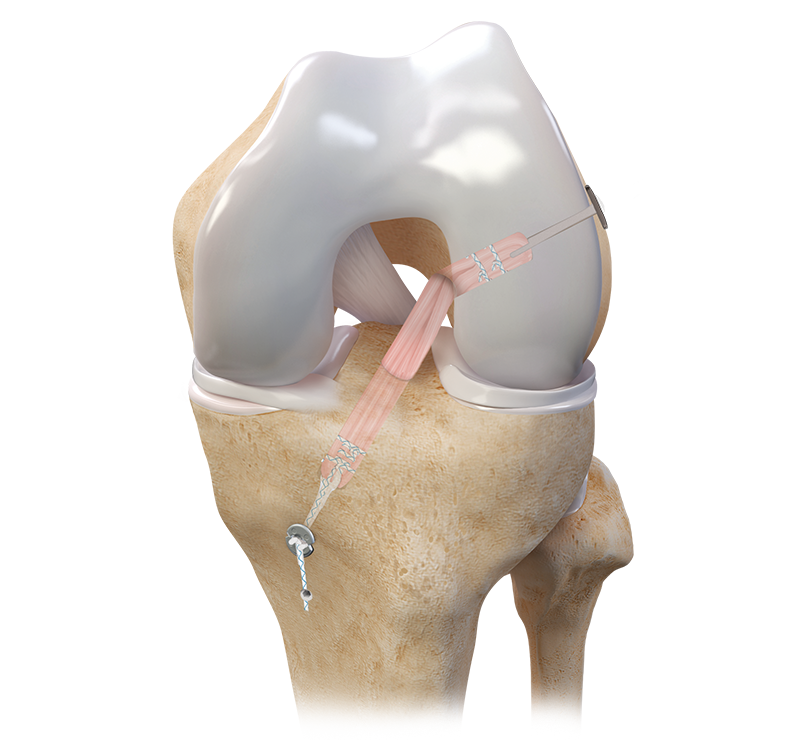 Arthrex - Autograft GraftLink Implant System, for